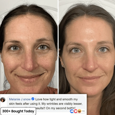 Plump Back Volume In Your Under Eyes, Lips & Smile Lines