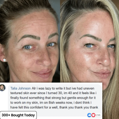 Plump Back Volume In Your Under Eyes, Lips & Smile Lines