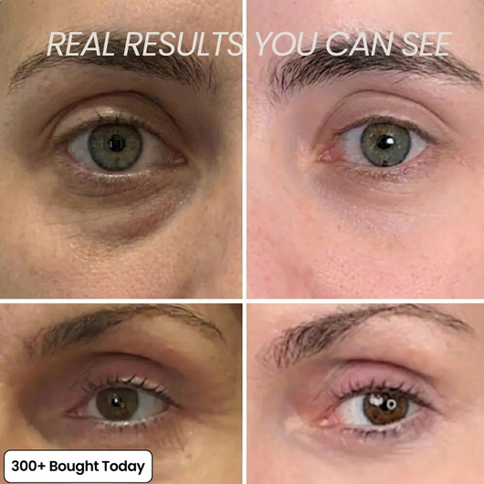 Plump Back Volume In Your Under Eyes, Lips & Smile Lines