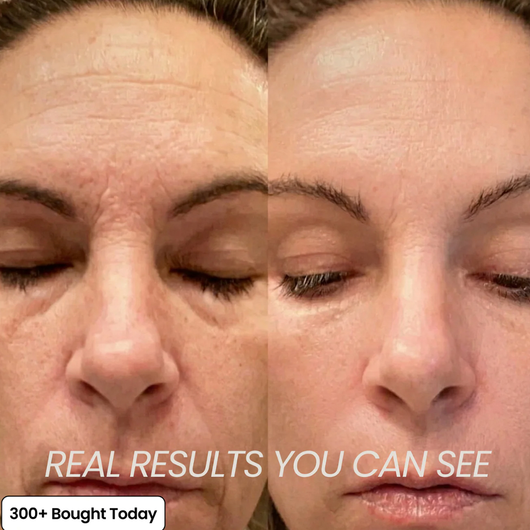 Plump Back Volume In Your Under Eyes, Lips & Smile Lines