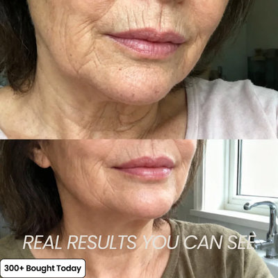 Plump Back Volume In Your Under Eyes, Lips & Smile Lines